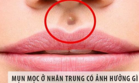 Mọc mụn ở nhân trung