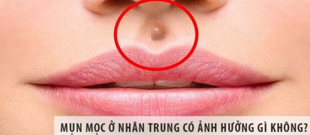 Mọc mụn ở nhân trung